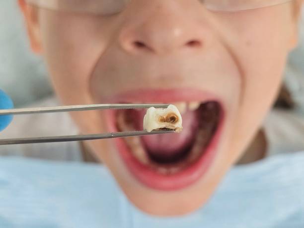 Best Knocked-Out Tooth Emergency  in Murrieta, CA